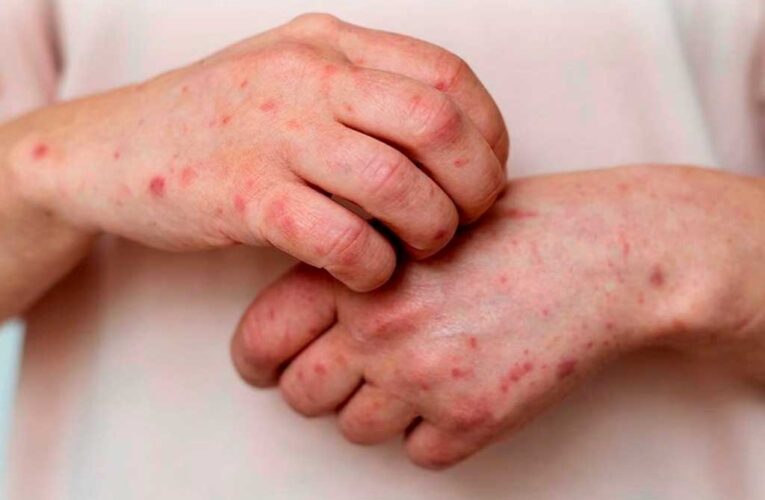 Recomendaciones del ministerio de Salud ante casos de viruela símica en Argentina