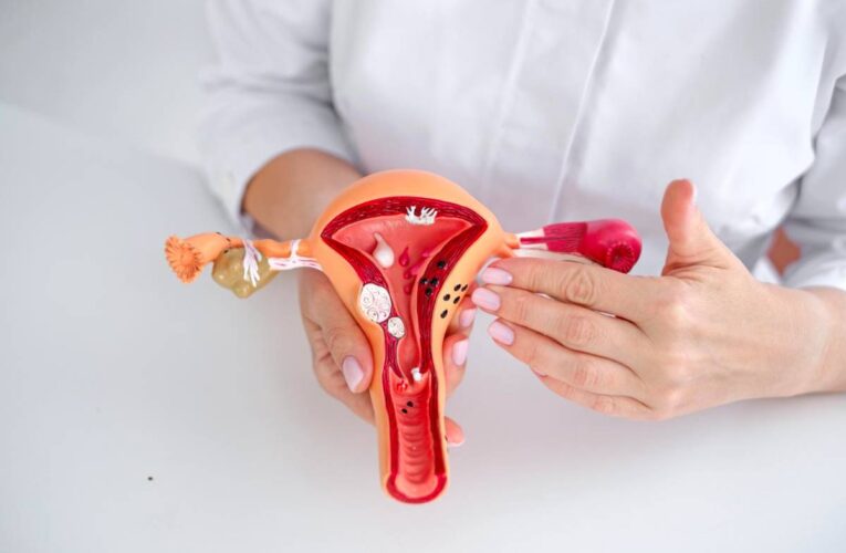 Endometriosis: La progesterona y el desarrollo de nuevas terapias
